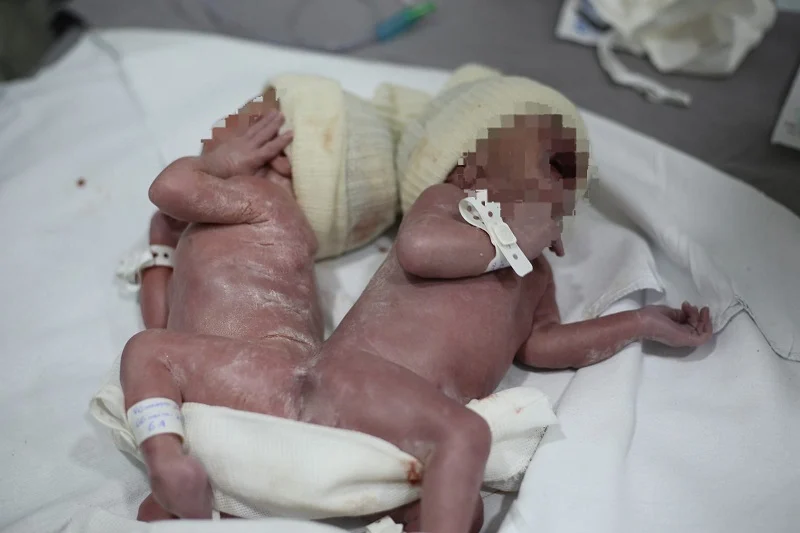 Imagem Em caso raro, gêmeos nascem unidos por osso da coluna no Paraná